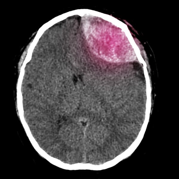 Hematomas intraparenquimatosos