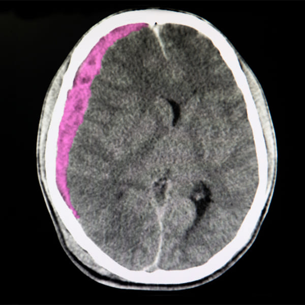 Hematomas subdural y epidural