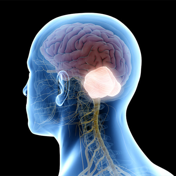 Malformación Chiari